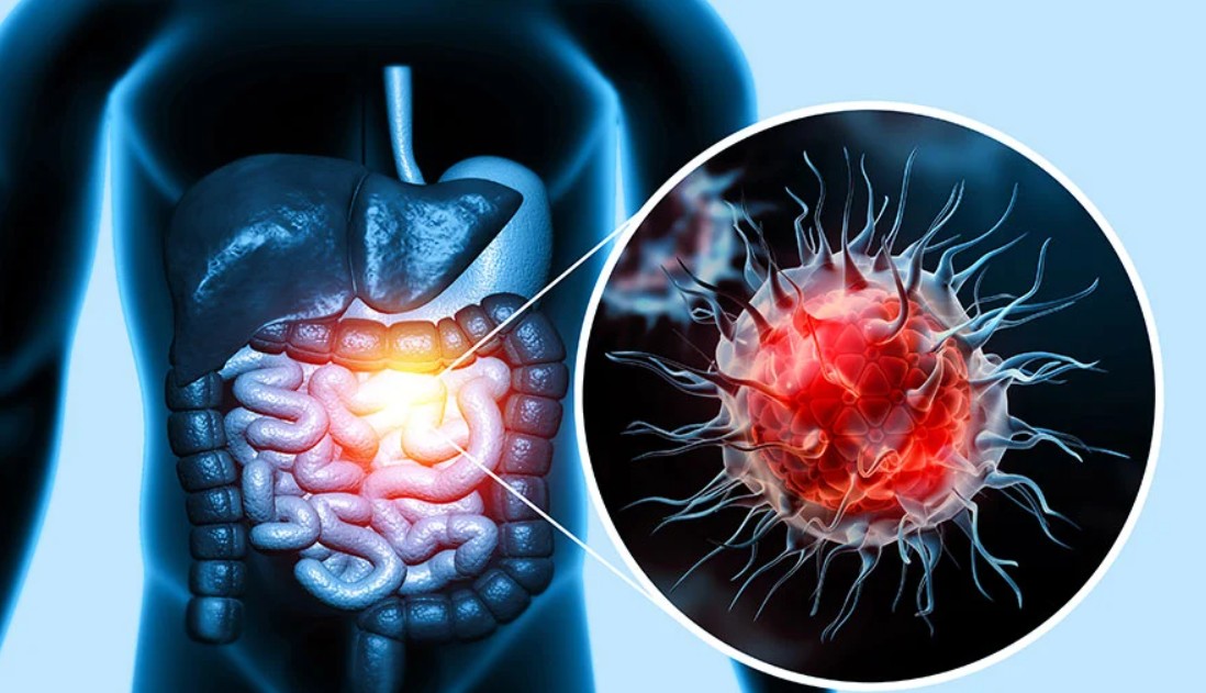 Understanding Cancer - Effects on the Body, Causes, and Treatment Approaches